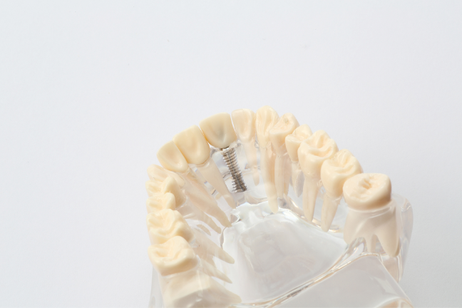 インプラント