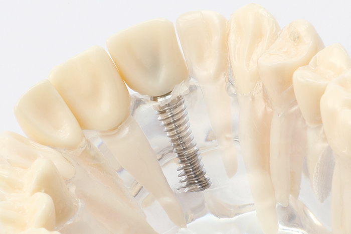 インプラント治療とは